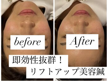 ユアン(YUAN)/美容鍼