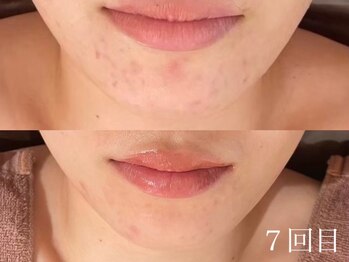 ホワイトアクア 天王寺本店(WHITE AQUA)/ハーブピーリング/毛穴/天王寺