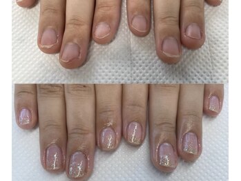 むしり爪を改善し美爪へ