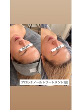 クラン(CLAN)/剥くだけじゃない！弾力アップ
