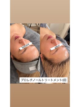 クラン(CLAN)/剥くだけじゃない！弾力アップ