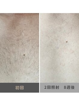 キムラケ 和光別邸(木村家 KIMURAKE)/メンズ脱毛　胸ビフォーアフター