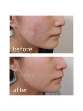 肌質改善サロン 姫路駅前店/肌質改善(敏感肌)