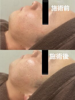 ツール(TOOL)/ハーブピーリング