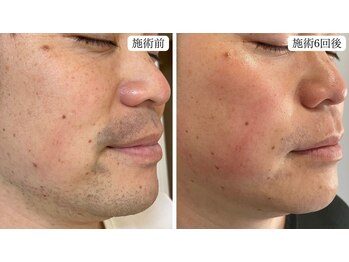 トパーズ 掛川店(Topaz)/メンズ脱毛 ヒゲ脱毛