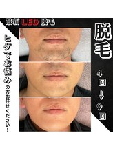 リノミラ(LINOMIRA)/LED脱毛