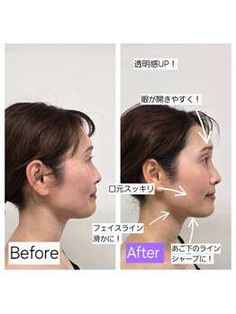 ハリ ヴァカンス(Hari Vacances)/美容鍼×顔筋フェイシャル