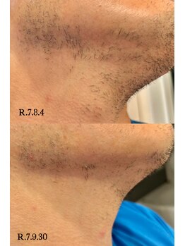 クラルス(Clarus)/髭脱毛