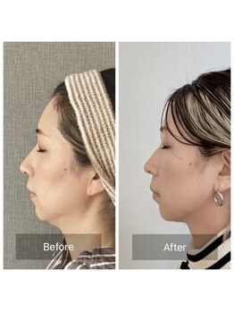 キュープ 北千住店(Qpu)/ビフォーアフター(二重あご)