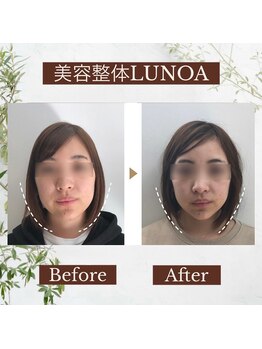 ルノア 梅田院(LUNOA)/小顔矯正[梅田/小顔/エラ張り]