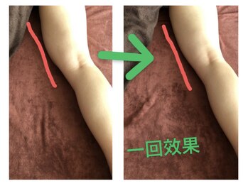 ひまわり 久屋店/新型ハイパーナイフ♪痩身