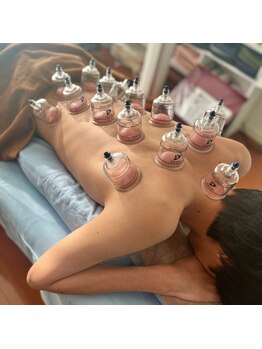 鍼灸マッサージ院 アカシア/新感覚の吸玉体験