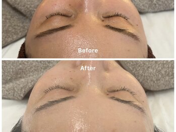 サロンアルーナ(Salon a Luna)/剥離しないハーブピーリング