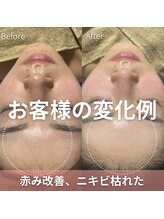 アイビーケア 三田(ivy care)/ニキビ枯れた！赤み改善