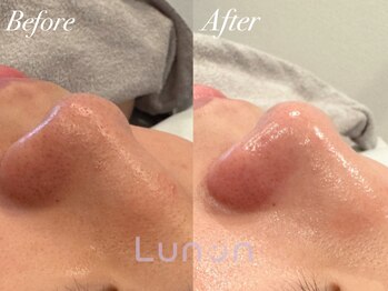 ルノン(Lunon)/毛穴洗浄ハイドロ