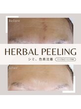 ココ(KOKO)/ハーブピーリングBeforeAfter
