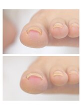 リペディア 熊谷(RePedia)/爪の横側が皮膚に食い込んだ例
