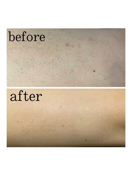 フェザー(feather)/カミソリとシュガーリングの違い