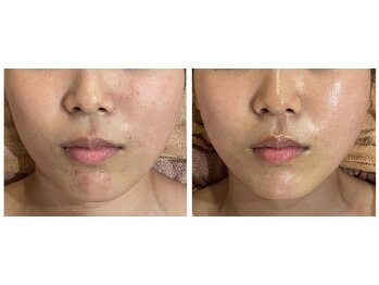 ロッシュ フェイス(Roche Face)/20代女性