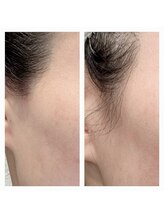 メイクアップス(makeups)/waxもみあげ脱毛