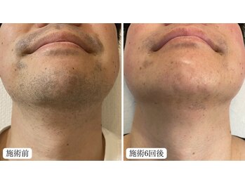 トパーズ 掛川店(Topaz)/メンズ脱毛 ひげ脱毛