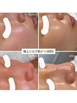 ビオエル(Bioell)/揺らぎ肌にも効果抜群♪♪