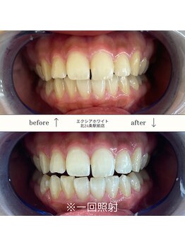 エクシアホワイト 平岸駅前店/ホワイトニングビフォーアフター