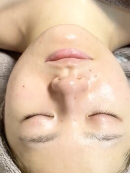 美ハグ 横浜青葉台(美hug)の写真/【毛穴の黒ずみをごっそり解消♪】毛穴大洗浄＆韓国発のスキンケアで大人女性のための本気の肌質改善！