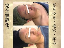 サンテボーテ(Sante Beaute)/オトナの肌荒れにはこれ一択