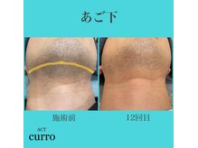 アクト クロ(ACT curro)/【あご下】脱毛施術例