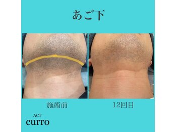 アクト クロ(ACT curro)/【あご下】脱毛施術例