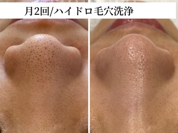 トリニエンス 南流山店/20代/ハイドロ毛穴洗浄
