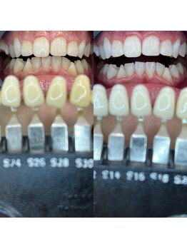 トウキョウスワーズ 池袋店(TOKYO SWRS)/#ホワイトニング #池袋 #渋谷
