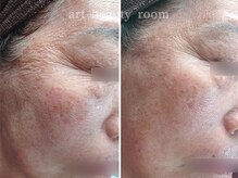 アート ビューティールーム(art beauty room)/☆OPL 光フェイシャル