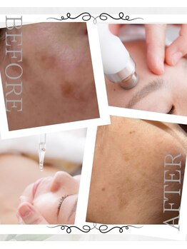 ピュアル 川口(Pual)/目立つシミ/広がるシミ/複数シミ