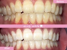 エクシアホワイトニング 札幌中島公園店/Before After［ホワイトニング］