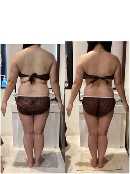 ミラヴィエ(Miravie)/脂肪分解レモンボトル2回の効果