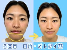 ナチュラルパーフェクトフェイス 新宿/２回目・アゴ肉【新宿駅小顔】