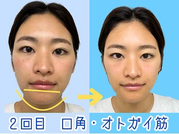 ナチュラルパーフェクトフェイス 新宿/２回目・アゴ肉【新宿駅小顔】