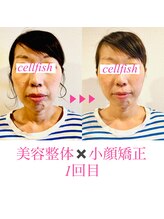 セルフィッシュ(Cellfish)/小顔矯正