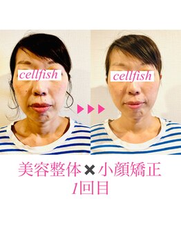 セルフィッシュ(Cellfish)/小顔矯正