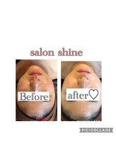サロンシャイン(Salon Shine)/ハーバルピールレベル7