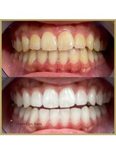 ライトケアサロン 銀座店(Light Care Salon)/セルフホワイトニングの症例写真