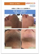 ケースタイル(k.style)/ヒゲ脱毛