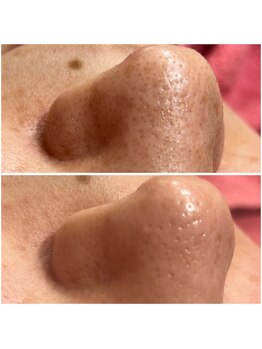 リンク(LiNK)/韓国式3D毛穴洗浄