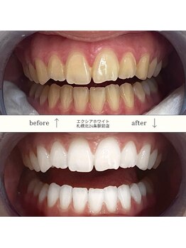 エクシアホワイト 平岸駅前店/ホワイトニングビフォーアフター