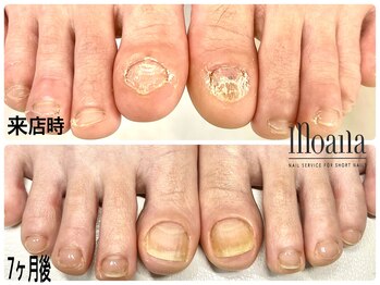 フット人工爪深爪