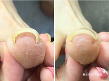 コバコ(kobaco)の雰囲気（巻き爪でお悩みの方、是非一度ご相談ください。）