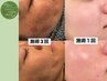 【NEW】ツル・ピカ♪韓国式ハーブピーリング