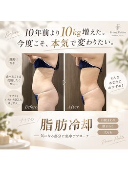 プリマプリート 可児店の写真/【最強痩身！脂肪冷却２cup￥8800】結果重視!キャビテーション+脂肪分解液導入付き！頑固な二段腹もお任せ★
